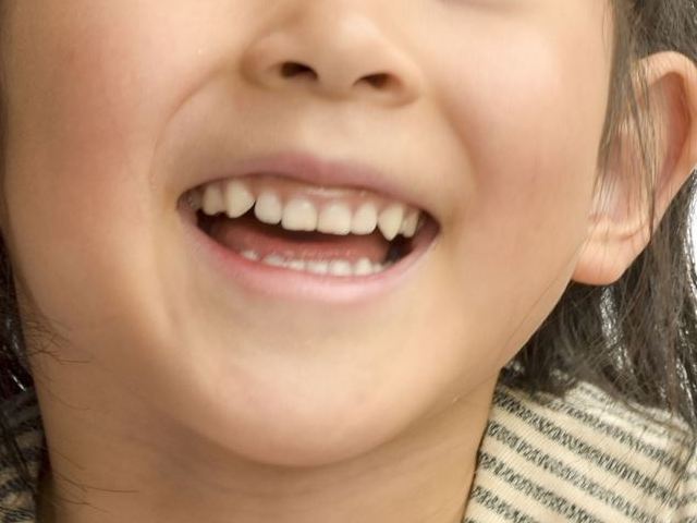 八重歯は抜歯した方がいい？矯正など治療方法の疑問を解決