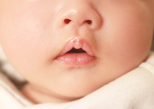 【小児矯正】歯科矯正が必要になる子どもの悪い習慣3つと直し方