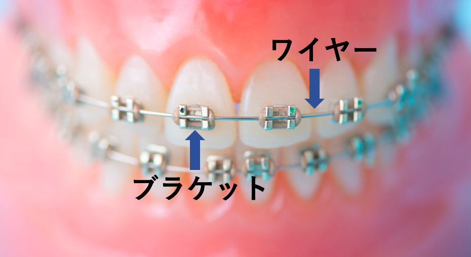 ブラケットとワイヤー