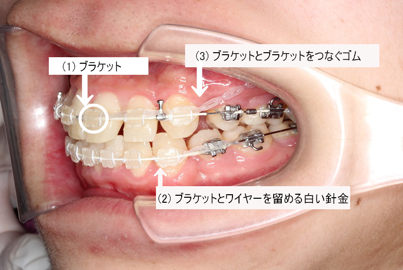 ブラケットとゴムの説明