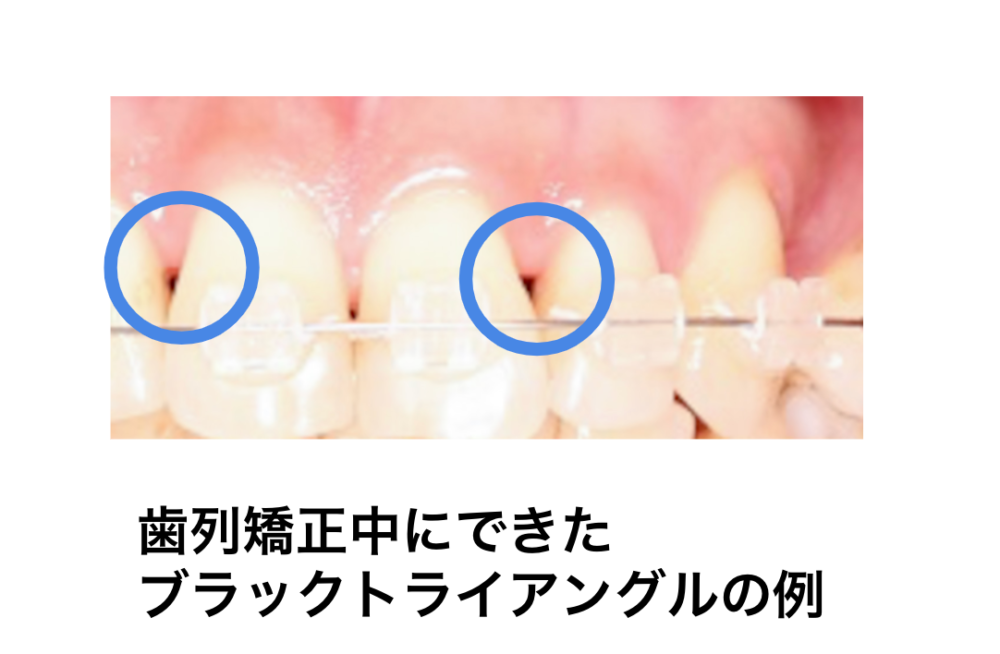 ブラックトライアングルの原因・予防方法から治療方法まで【医師監修】