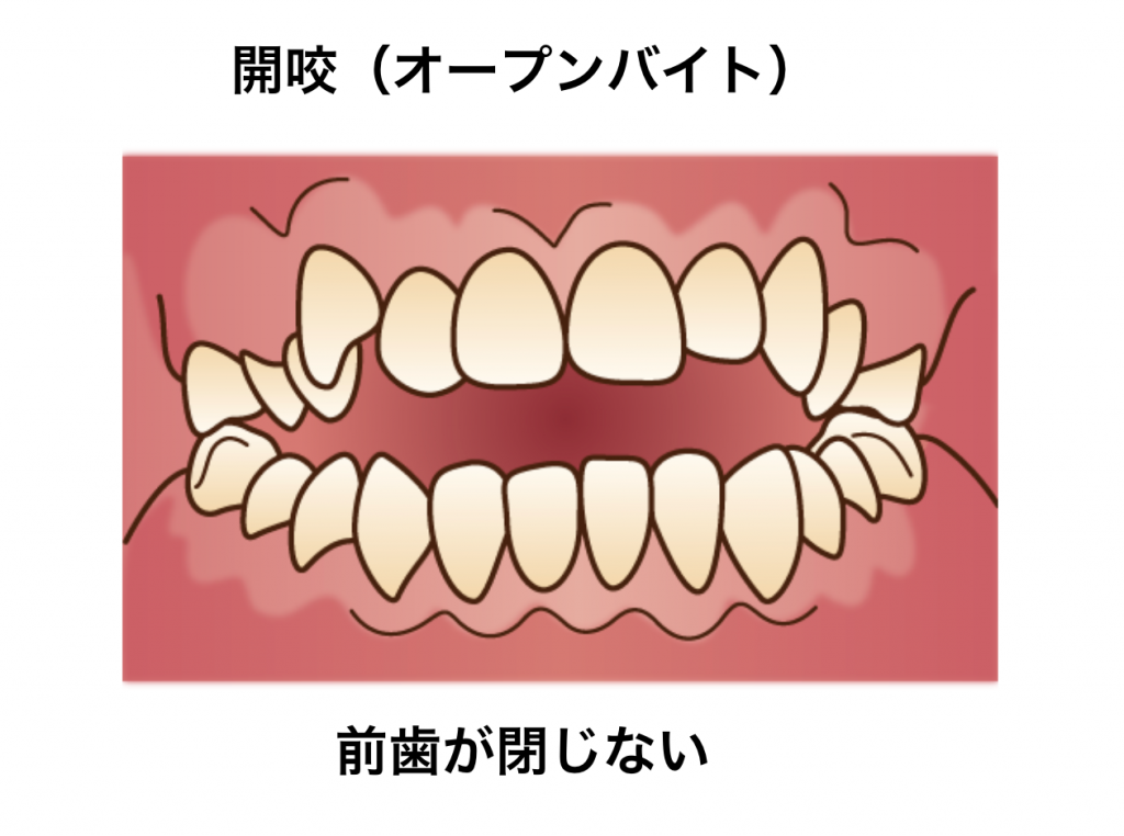 オープンバイト｜歯列矯正｜矯正中のトラブル相談＿葛西モア