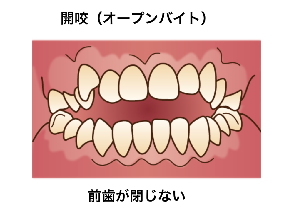 オープンバイト｜歯列矯正｜矯正中のトラブル相談＿葛西モア