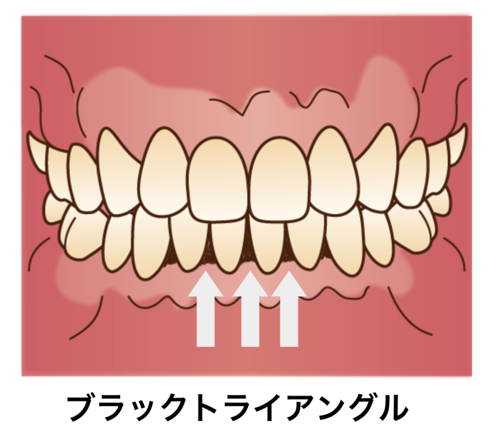 ブラックトライアングル｜ドクターに聞く歯列矯正「ブラックトライアングル」って何？＿葛西モア