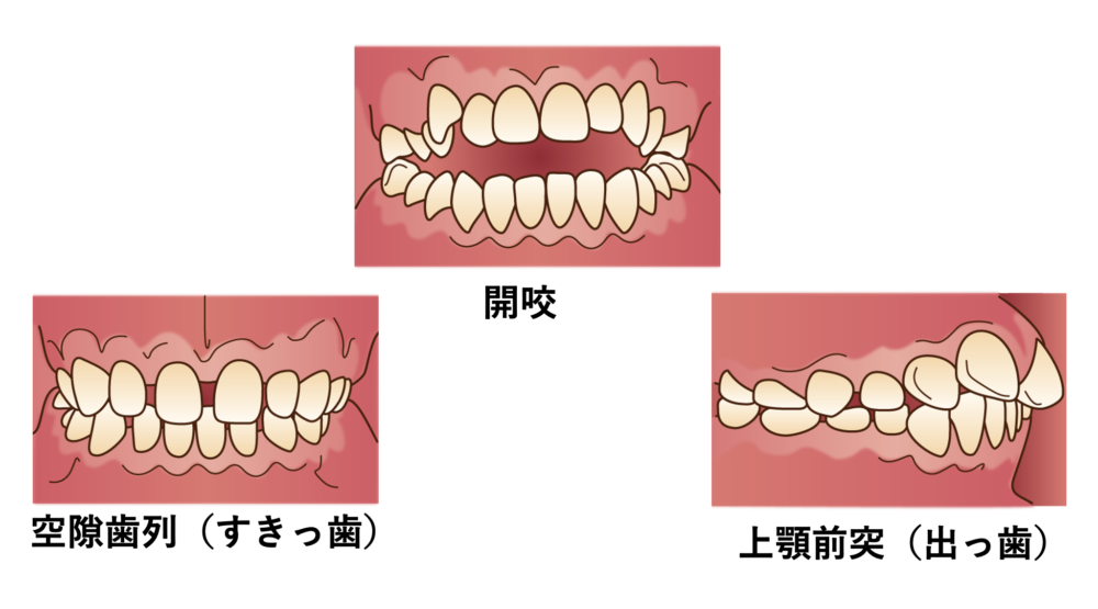 矯正で歯が動きにくい不正咬合の種類