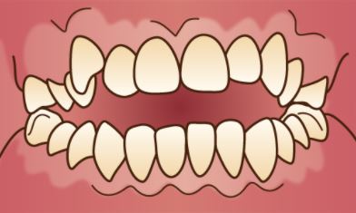 前歯が閉じない「開咬」のイラスト