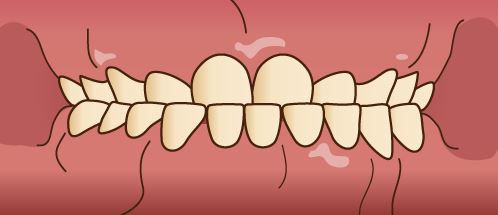 下顎が突出している「受け口」のイラスト