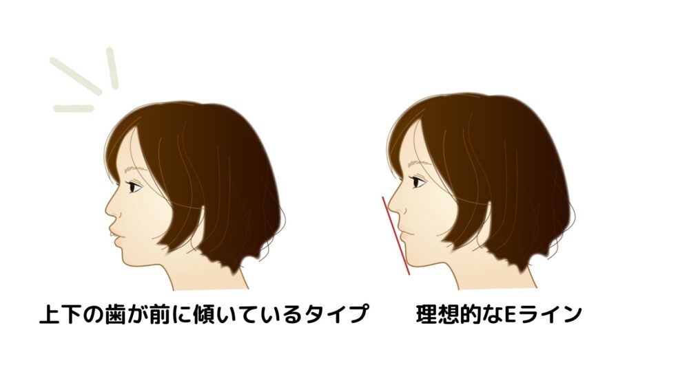 上下の歯が前に傾いている