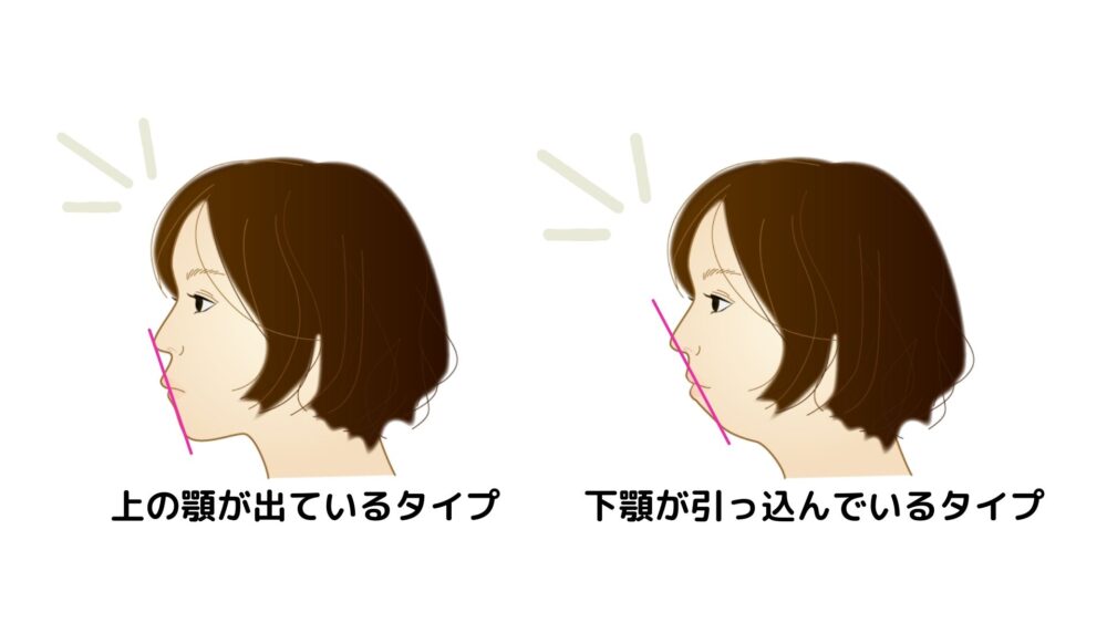 上の顎が出ている